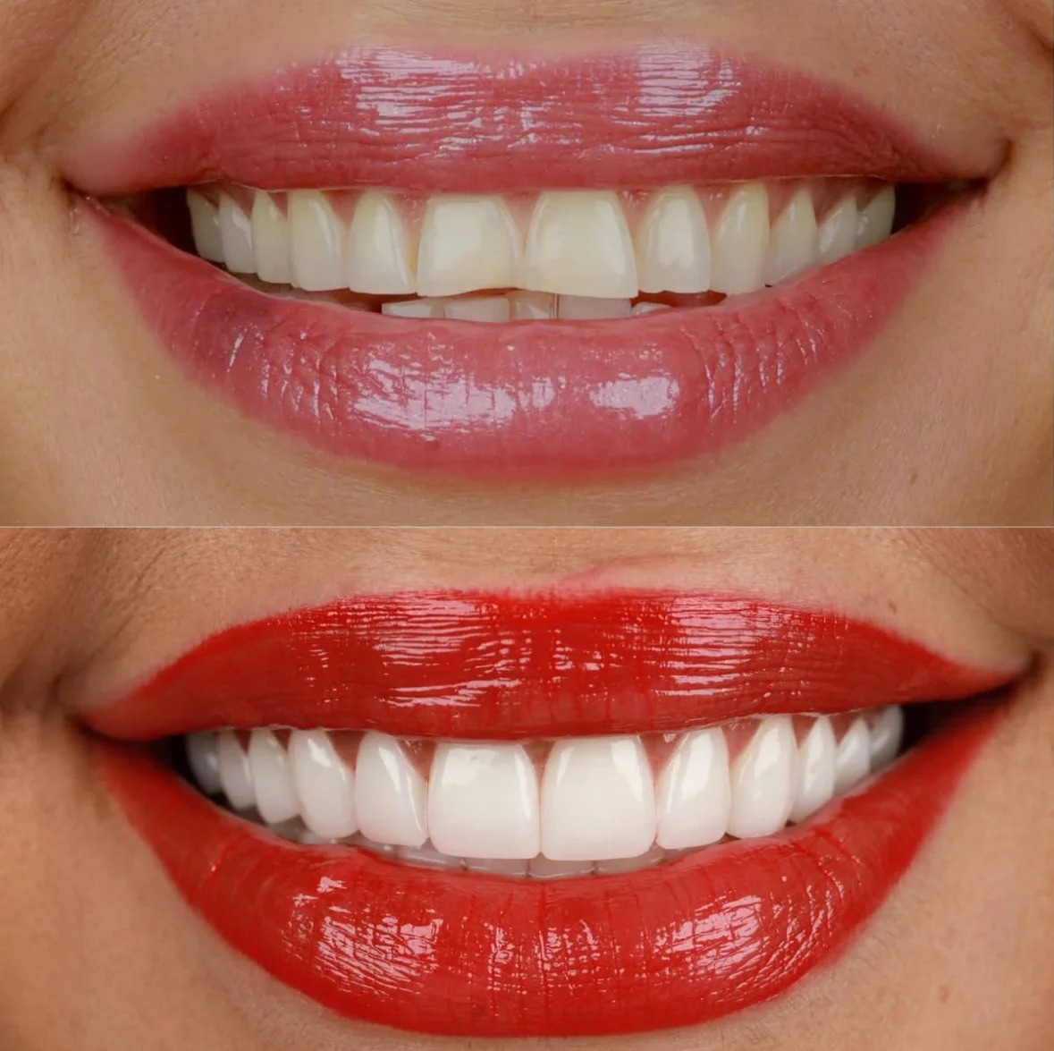 Full transformation: before treatment, the smile exhibited misalignment, crowding, and dullness; after treatment, cosmetic alignment paired with expert whitening yielded properly positioned, vibrant teeth with healthy, natural contours.